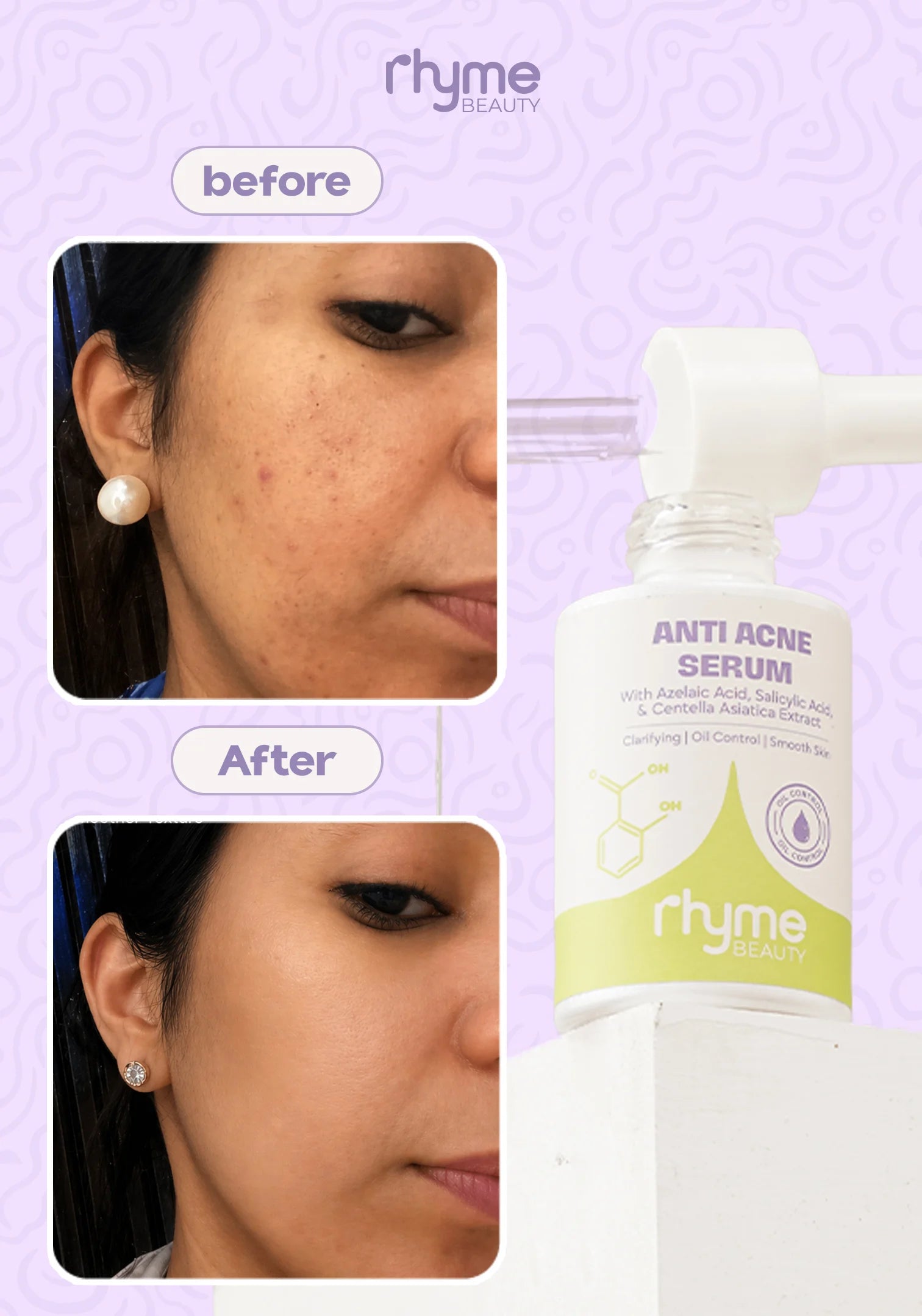 Anti Acne Serum